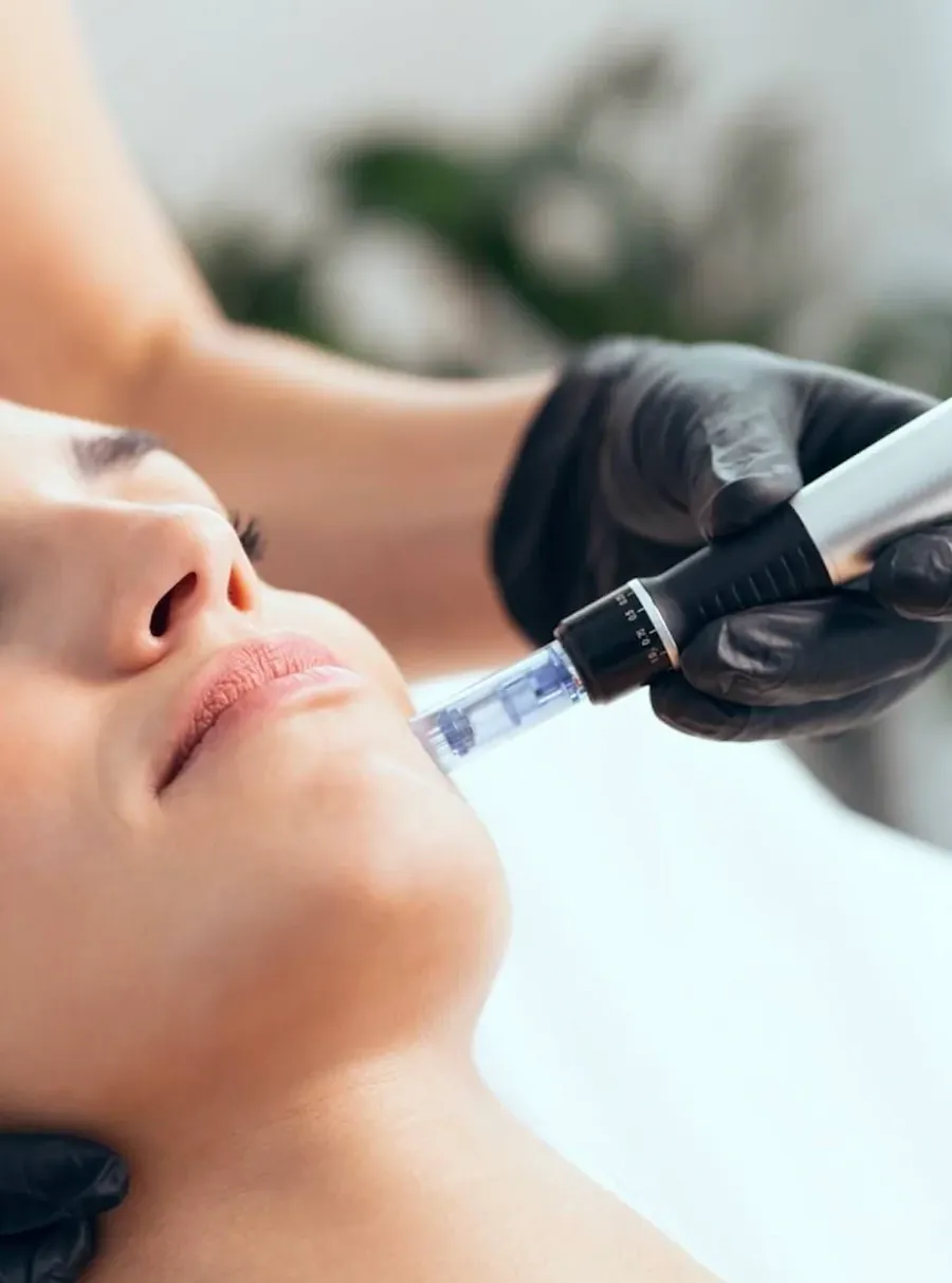 Microneedling-Behandlung im Gesicht